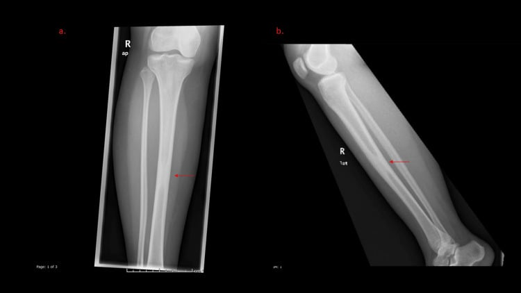 Radiograph and CT of focal circumferential endosteal thickening of the mid-tibial shaft.