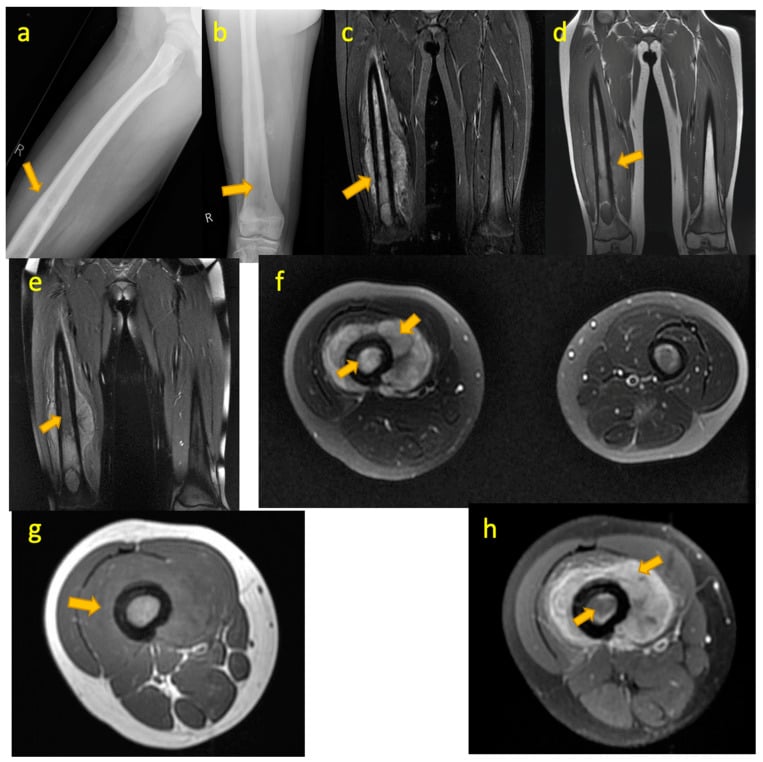 Femoral radiographs and MRI of a 13-year-old with an ill-defined permeative diaphyseal lesion.