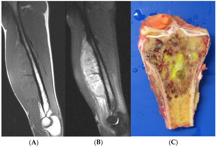 Sagittal T1 and STIR MRI of a humeral Ewing sarcoma with a soft-tissue mass larger than the osseous component, and the resection specimen.