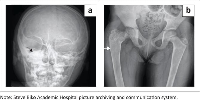 Skull and pelvic radiographs showing unilateral expansile sclerotic fibrous dysplasia with the shepherd-crook proximal femur.