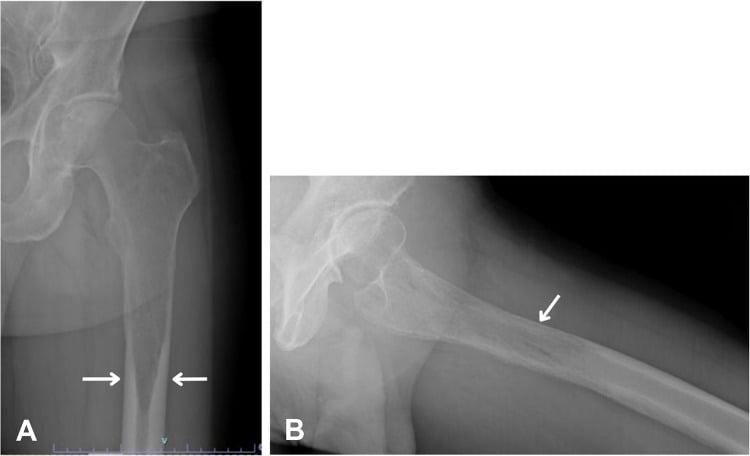 AP radiograph with a flame-shaped lytic lesion of the proximal diaphysis.