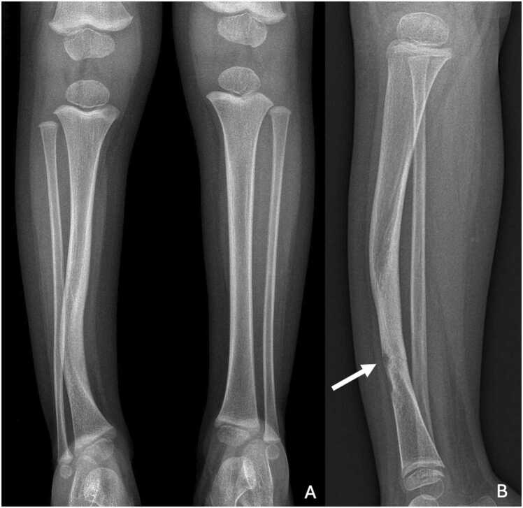 Radiographs of congenital anterolateral tibial bowing in neurofibromatosis type 1, complicated by fracture.