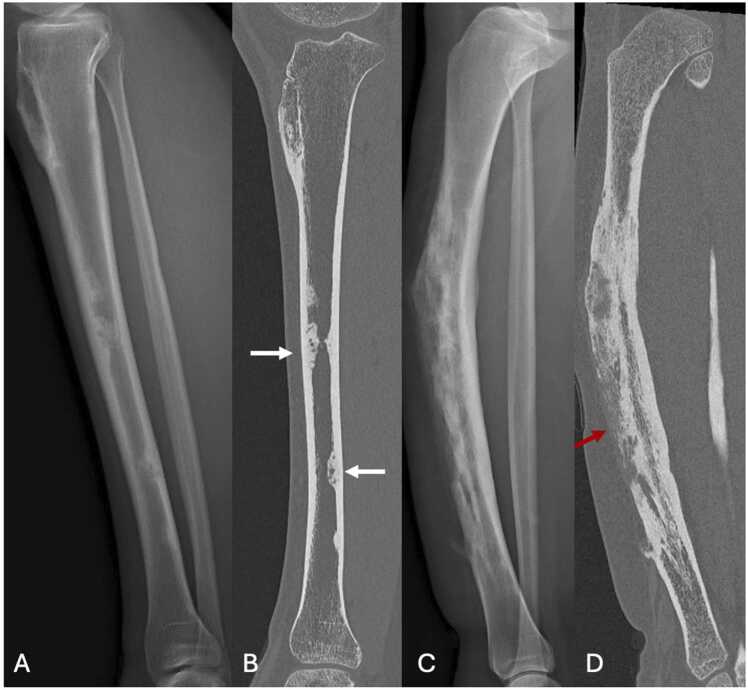 Tibial radiographs comparing multifocal osteofibrous dysplasia with adamantinoma in two patients.