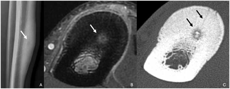 Radiograph, CT and MRI of a tibial diaphyseal osteoid osteoma with cortical thickening and a central nidus.