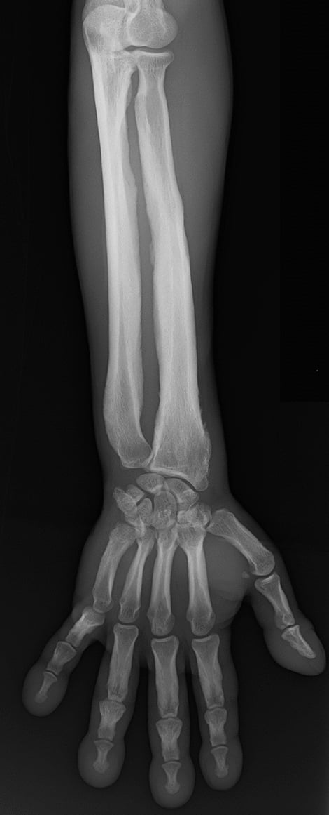 Hand and forearm radiograph with irregular periosteal reaction of the tubular bones and clubbing.