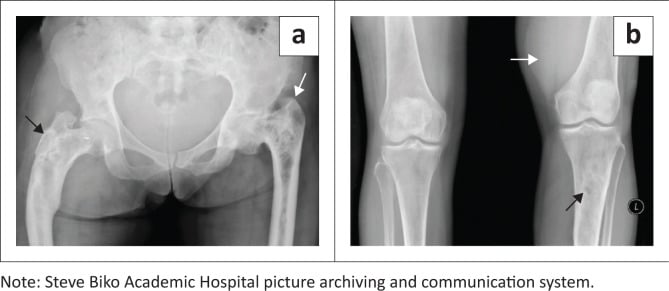 Pelvic and lower-limb radiographs with mixed lytic-sclerotic expansile lesions, varus bowing and the shepherd-crook deformity.