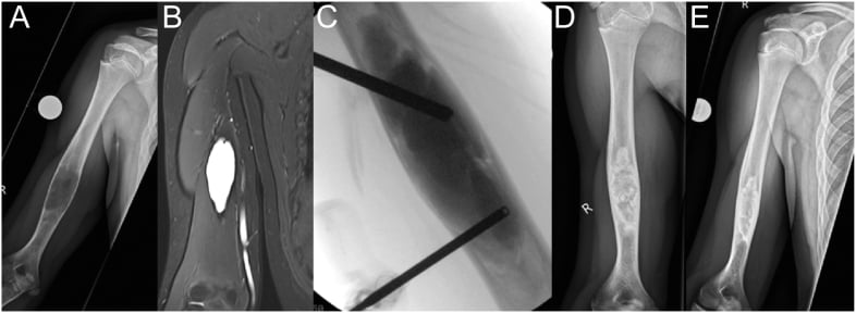Humeral radiograph and MRI of a simple bone cyst spanning the diaphysis.
