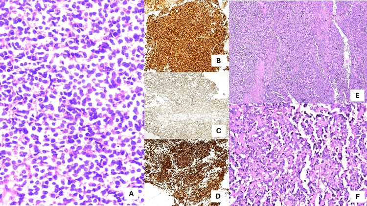 Histopathology of a malignant small round cell tumour with monotonous cells, scant cytoplasm and stippled chromatin.