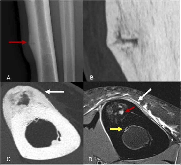 Serial radiograph, CT and MRI of a tibial diaphyseal stress fracture with cortical lucency and periosteal reaction.