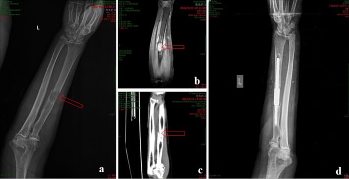 Preoperative radiograph, CT and MRI of a right ulnar diaphyseal metastasis and the postoperative reconstruction.
