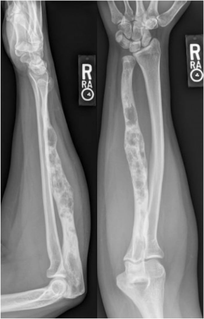 Ulnar radiograph with an enlarged shaft and a mixed lytic-blastic lesion involving most of the cortical width.