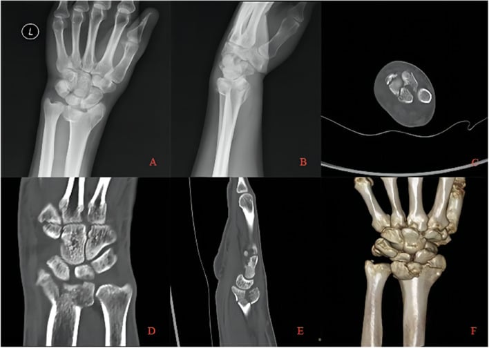 6-panel die-punch fracture pre-operative imaging with X-rays, CT, and 3D reconstruction