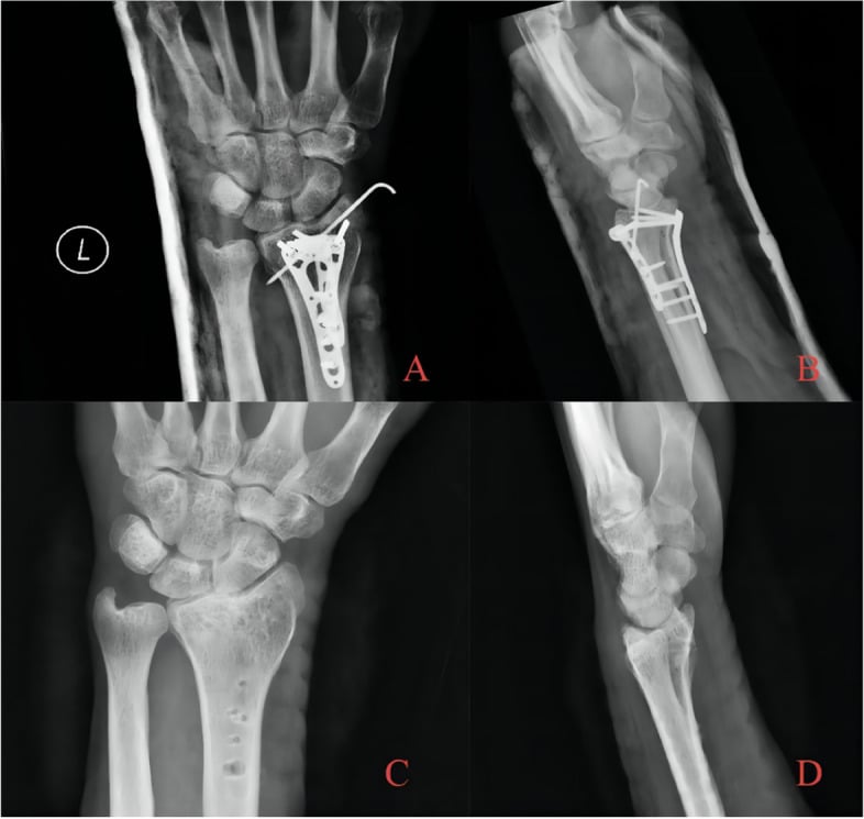 4-panel post-operative imaging showing combined dorsal and volar plate fixation with long-term follow-up
