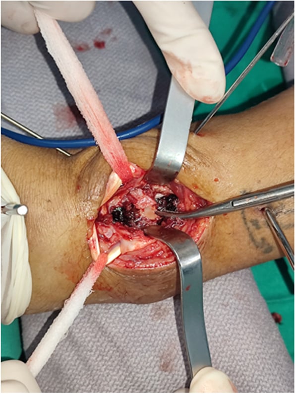 Intraoperative photo of dorsal approach showing die-punch bone fragments