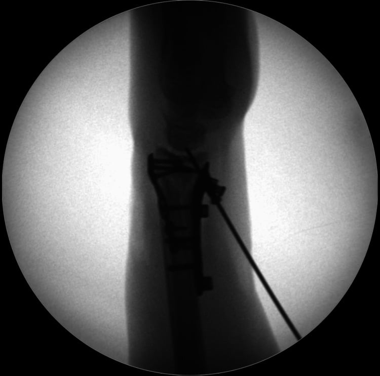 Operative lateral fluoroscopy showing combined volar and dorsal plate fixation of a complex distal radius fracture.
