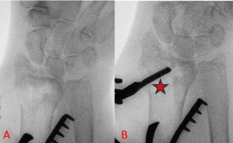 Operative fluoroscopic sequence showing direct elevation of a depressed die-punch fragment through a fracture window.