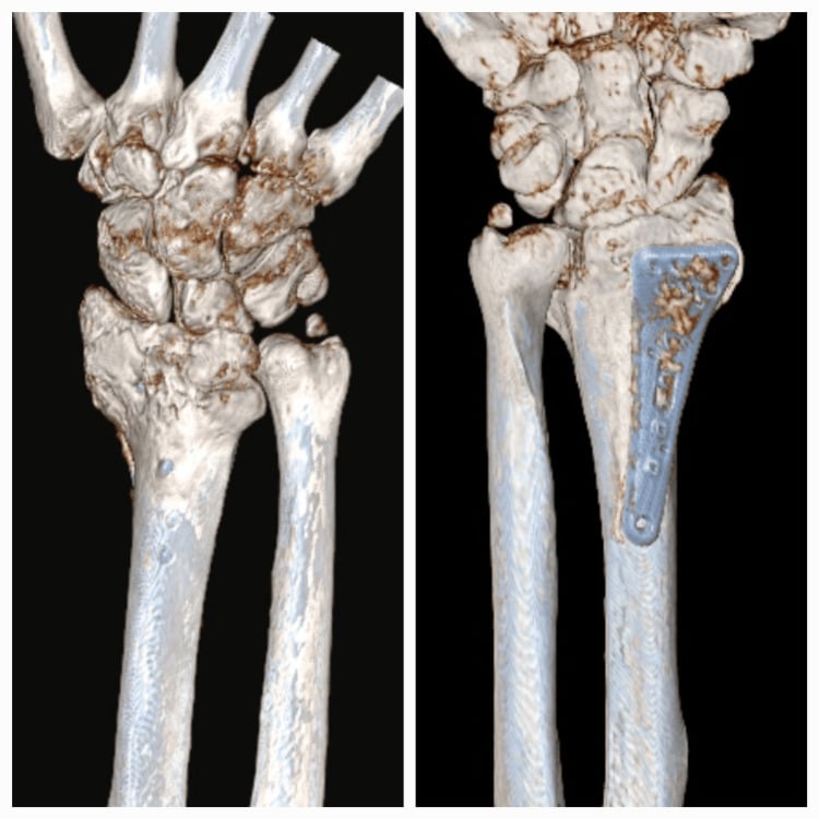 Postoperative CT showing a volar-plate screw protruding dorsally beside the extensor tendon compartments.