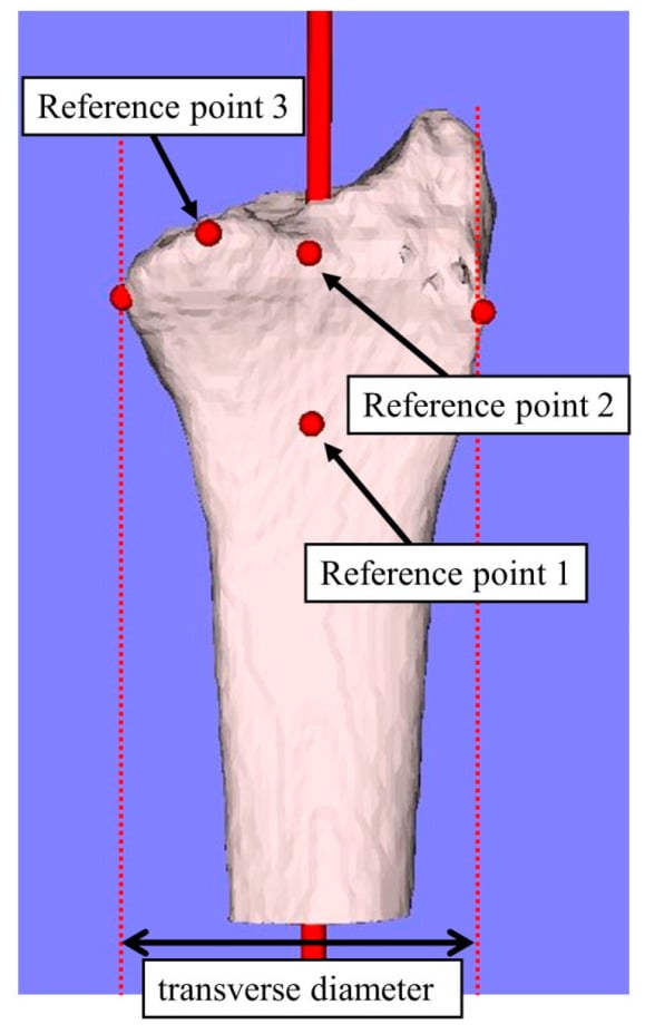 Three-dimensional distal radius anatomy model defining the volar cortical contour and lunate-facet reference points.