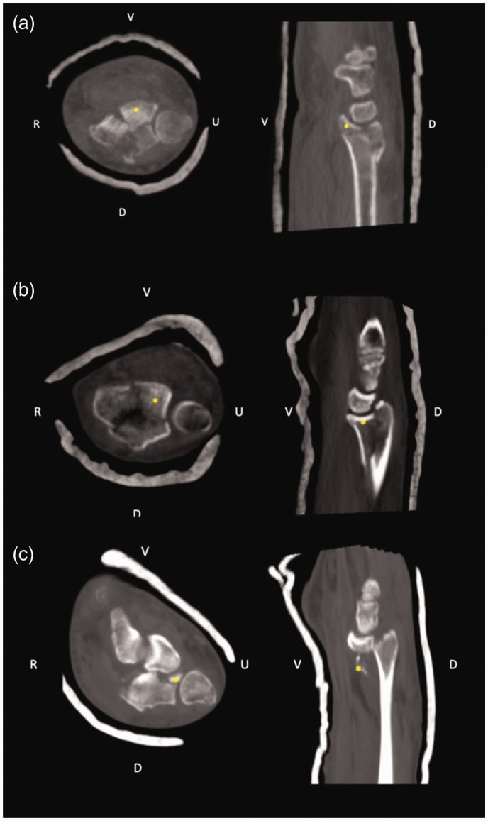 CT classification of type 1, type 2 and type 3 palmar-ulnar corner fragments of the distal radius.