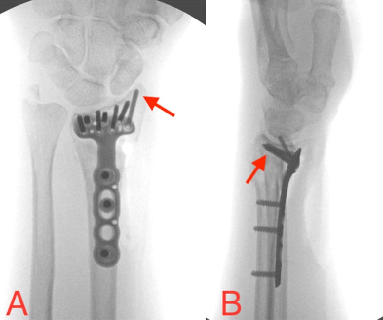 PA and lateral fluoroscopic views demonstrating subchondral screw assessment after volar distal radius plating.