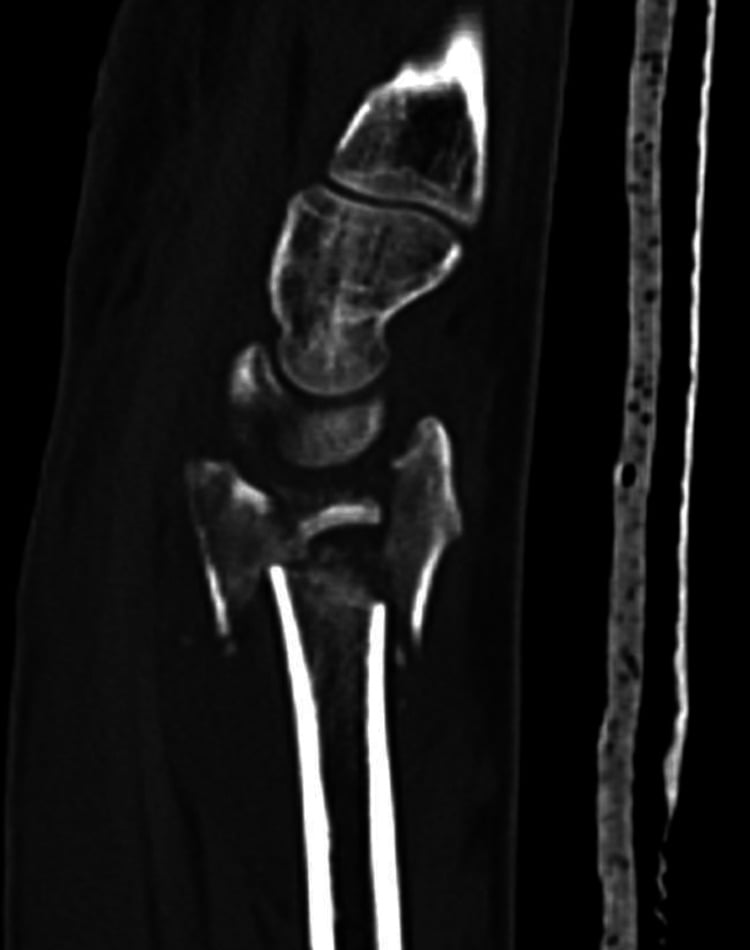 Sagittal CT investigation showing a lunate-fossa intercalary die-punch fragment rotated 180 degrees.