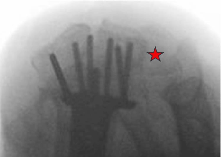 Intraoperative skyline fluoroscopic view checking distal locking-peg length and sigmoid-notch penetration.