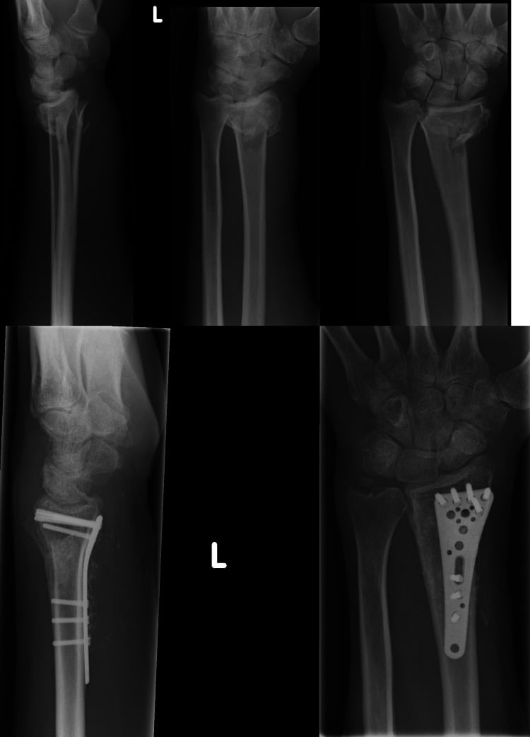 Preoperative and postoperative wrist radiographs showing a dense subchondral raft of distal locking screws.
