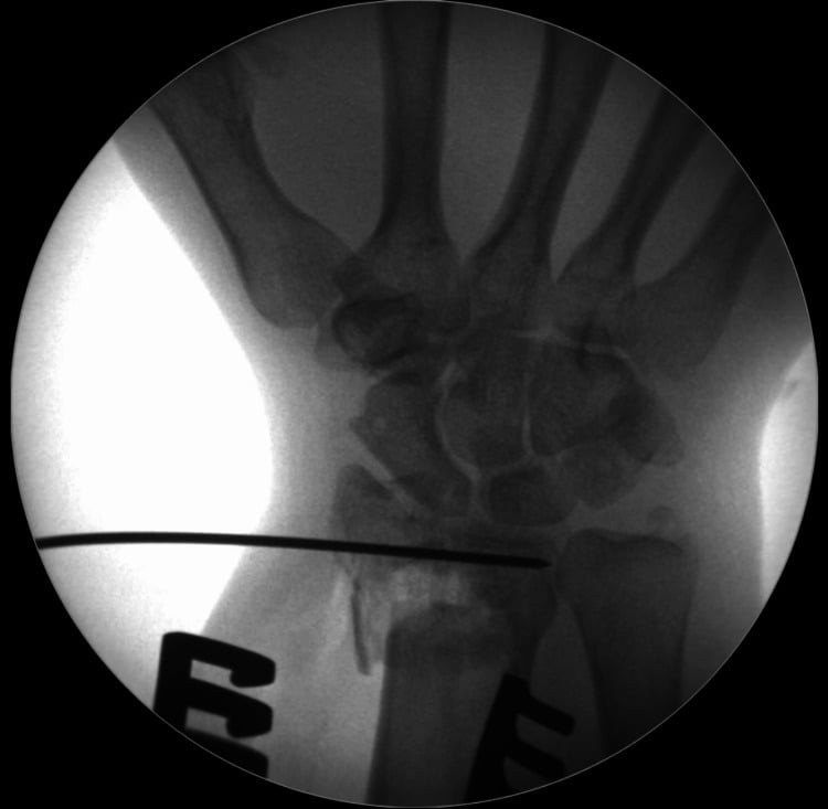 Operative fluoroscopy showing a radial-to-ulnar subchondral wire supporting an elevated die-punch fragment.