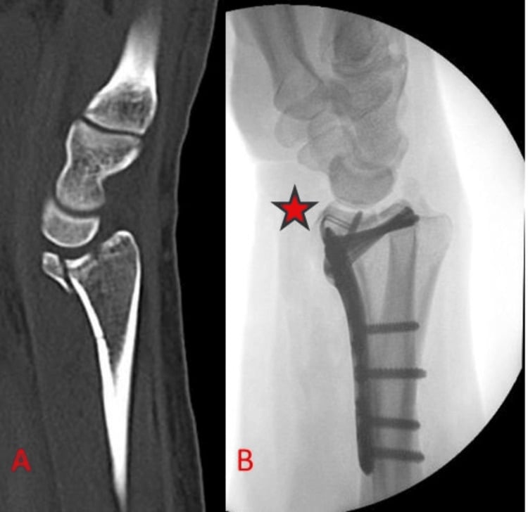Sagittal CT and operative lateral fluoroscopy showing separate hook fixation of a small volar lunate-facet rim fragment.