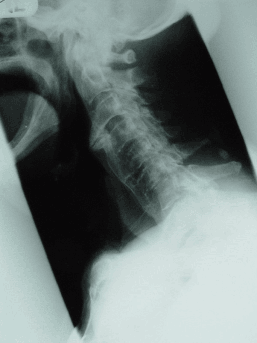 Lateral cervical radiograph with large anterior bridging osteophytes in DISH causing dysphagia