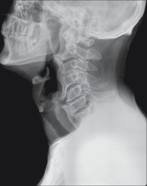Lateral cervical spine radiograph showing flowing anterior ossification of DISH