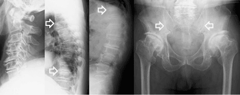 Four-panel radiograph composite showing DISH ossification in cervical, thoracic spine and pelvis