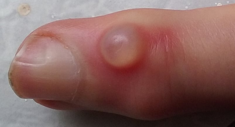 Digital mucous cyst on fingertip with nail grooving