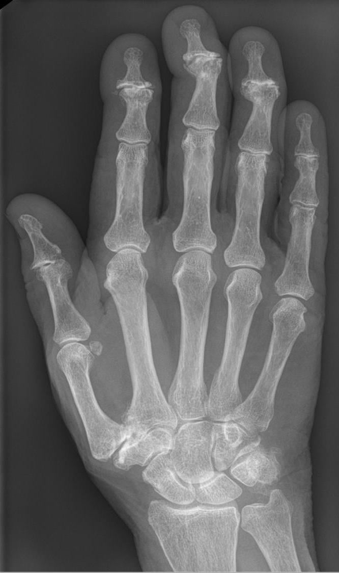 X-ray showing DIP osteoarthritis with Heberden's nodes