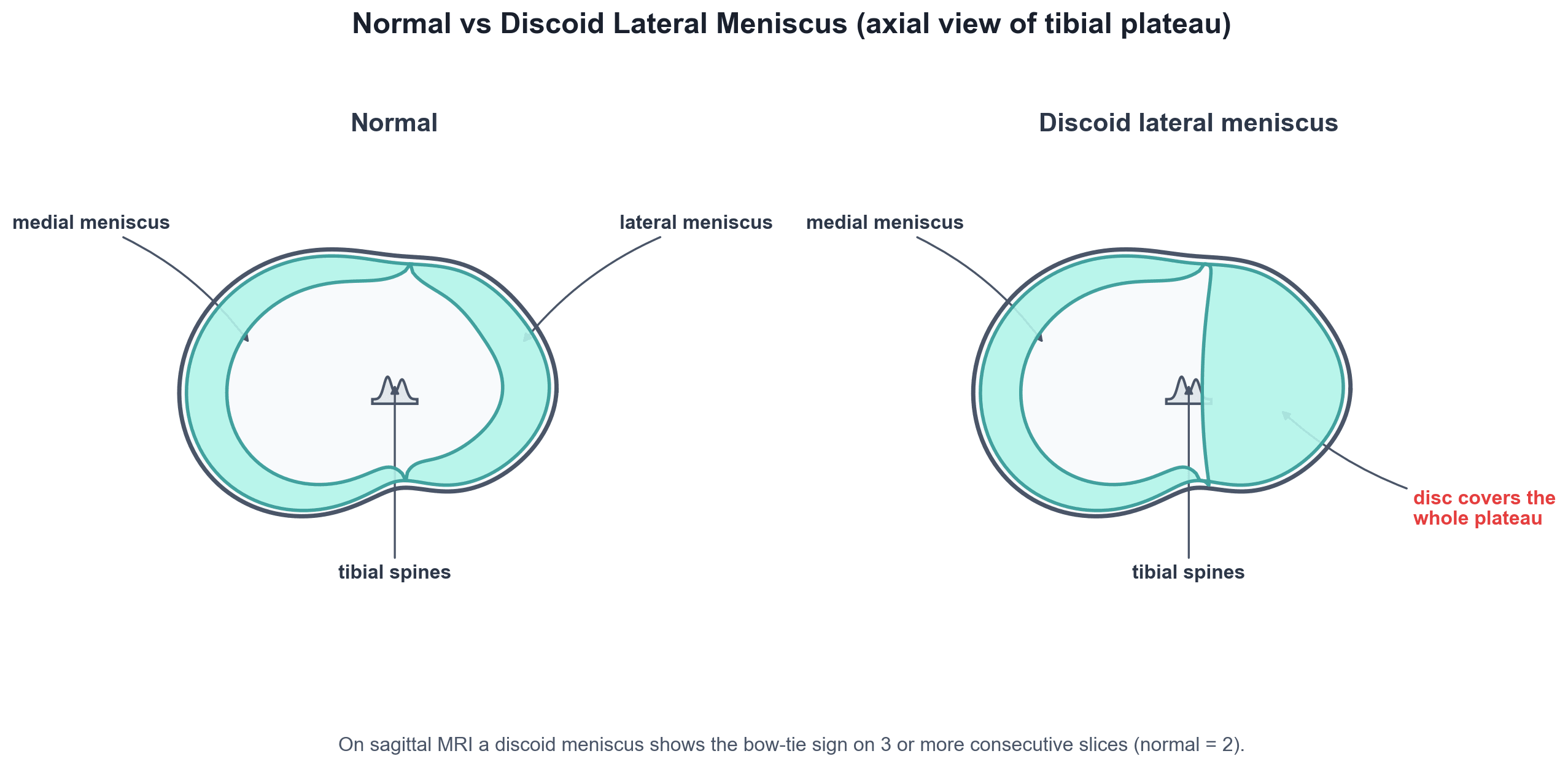 Diagram comparing a normal C-shaped lateral meniscus with a disc-shaped discoid lateral meniscus on an axial view of the tibial plateau