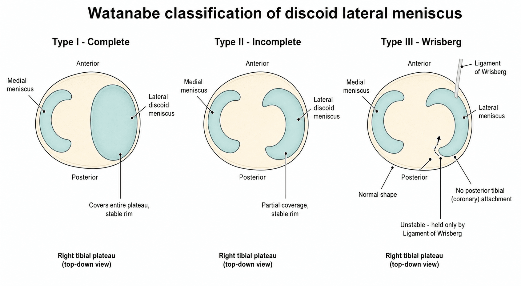 Three-panel top-down tibial-plateau schematic of the Watanabe classification: Type I complete disc, Type II incomplete disc, Type III Wrisberg variant with a normal-shaped but posteriorly-unattached lateral meniscus.