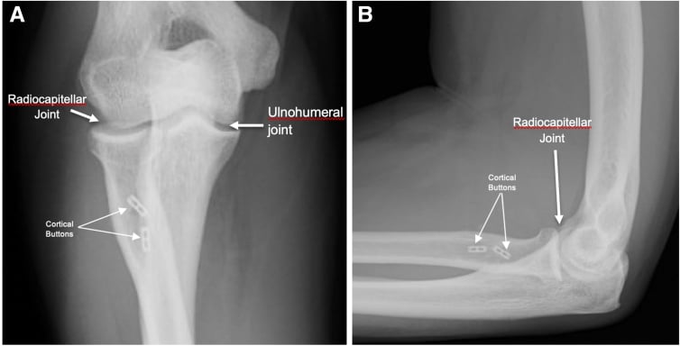 AP and lateral elbow radiographs demonstrating cortical button position following tension-slide repair