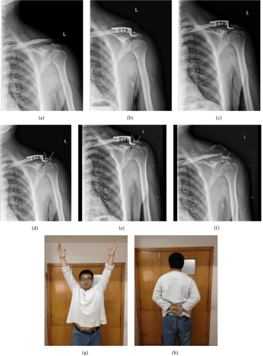 Serial radiographs showing subacromial osteolysis after clavicle hook plate fixation