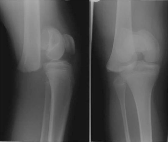 Salter-Harris type 1 distal femoral physeal fracture X-rays