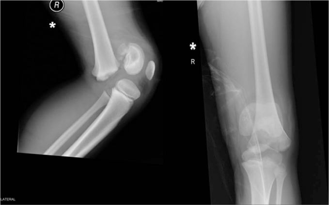 Salter-Harris type 2 distal femoral physeal fracture X-rays