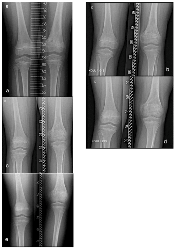 Serial anteroposterior radiographs of both knees with a measuring ruler documenting progressive limb-length discrepancy after distal femoral physeal arrest