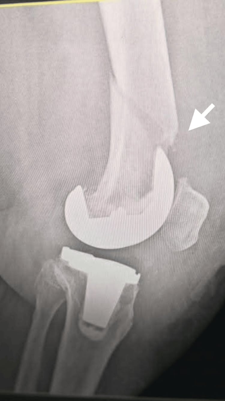Lateral radiograph demonstrating a supracondylar periprosthetic distal femur fracture