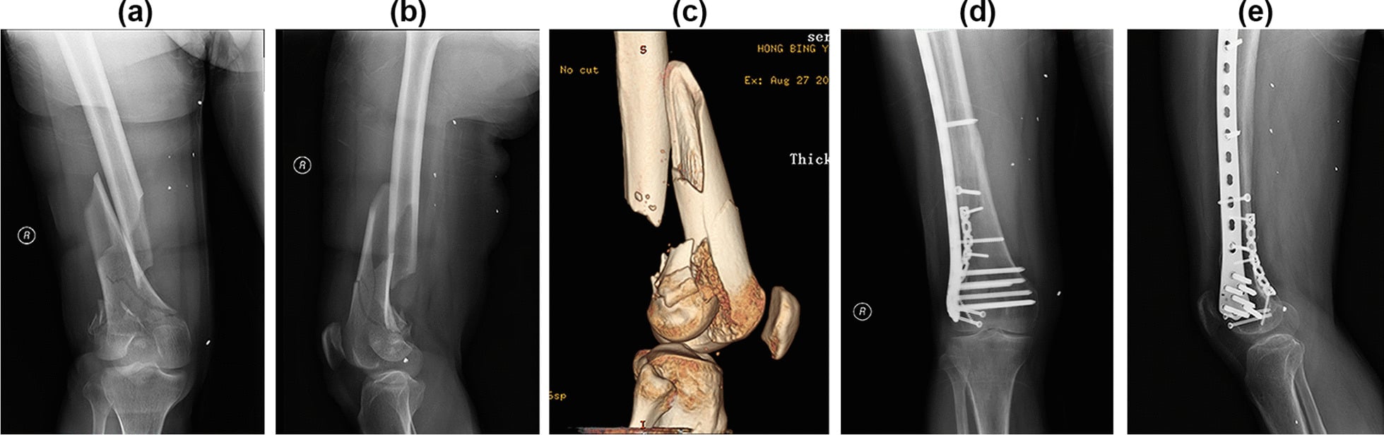Preoperative radiographs, 3D CT, and postoperative radiographs of distal femur fracture ORIF