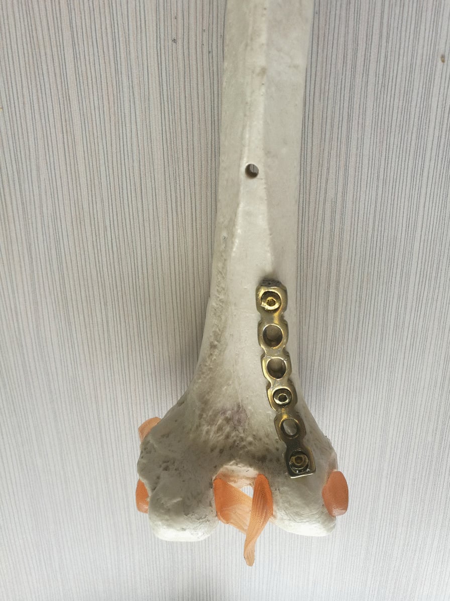 Sawbone model and schematic diagram of posterior anti-gliding plate fixation for Hoffa fracture
