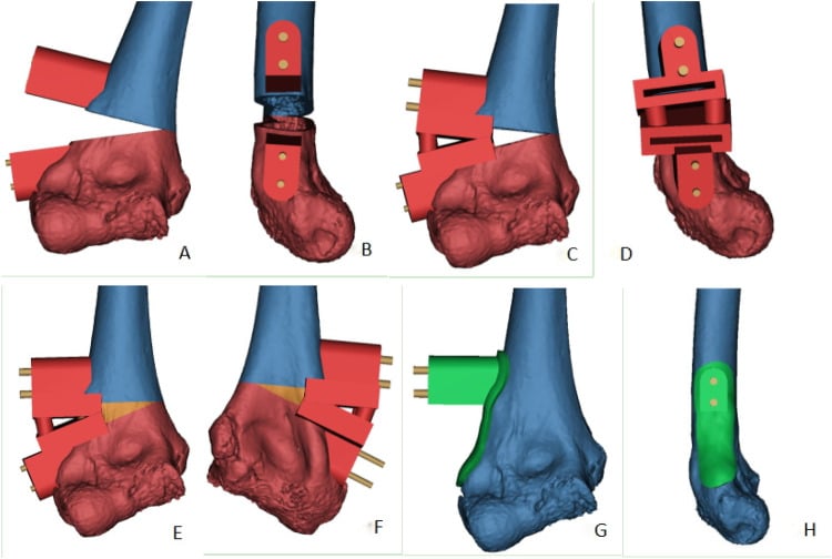 3D CAD surgical planning diagram for distal femoral osteotomy guide design