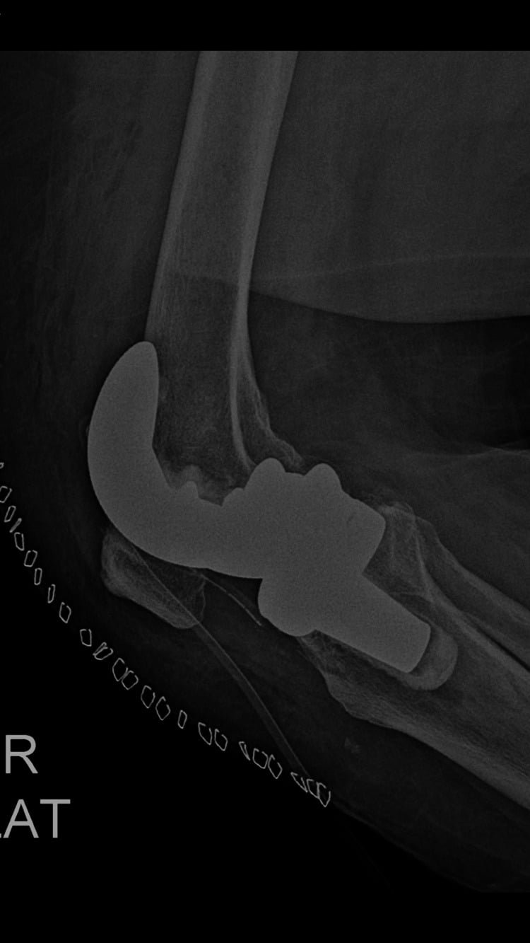 Postoperative lateral radiograph of periprosthetic distal femoral component alignment