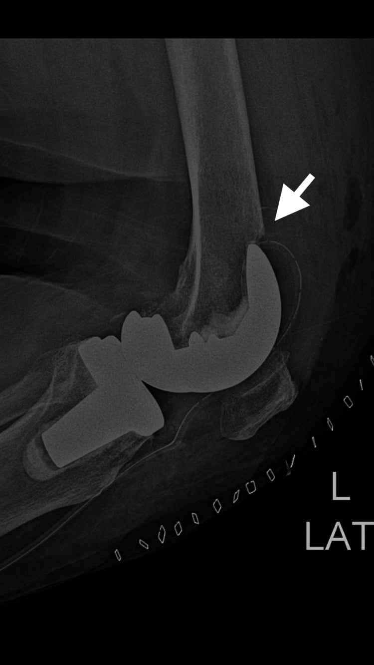 Postoperative lateral radiograph confirming femoral component placement