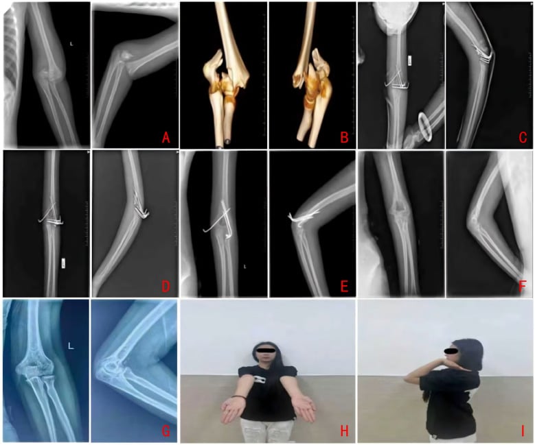 Radiographic series of a paediatric distal humeral intercondylar fracture before and after fixation