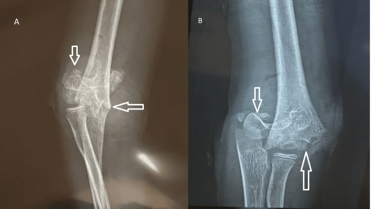AP and lateral radiographs of a Gartland type III extension supracondylar humerus fracture