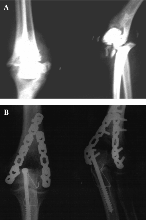 AP and lateral radiographs after bilateral plate fixation of a type C distal humerus fracture
